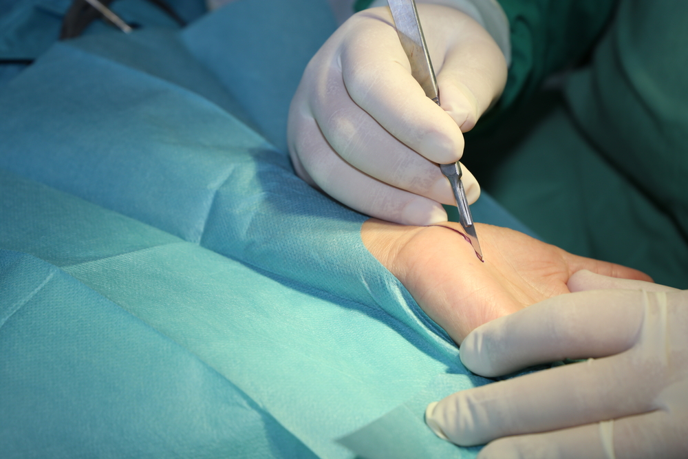 median nerve compression
